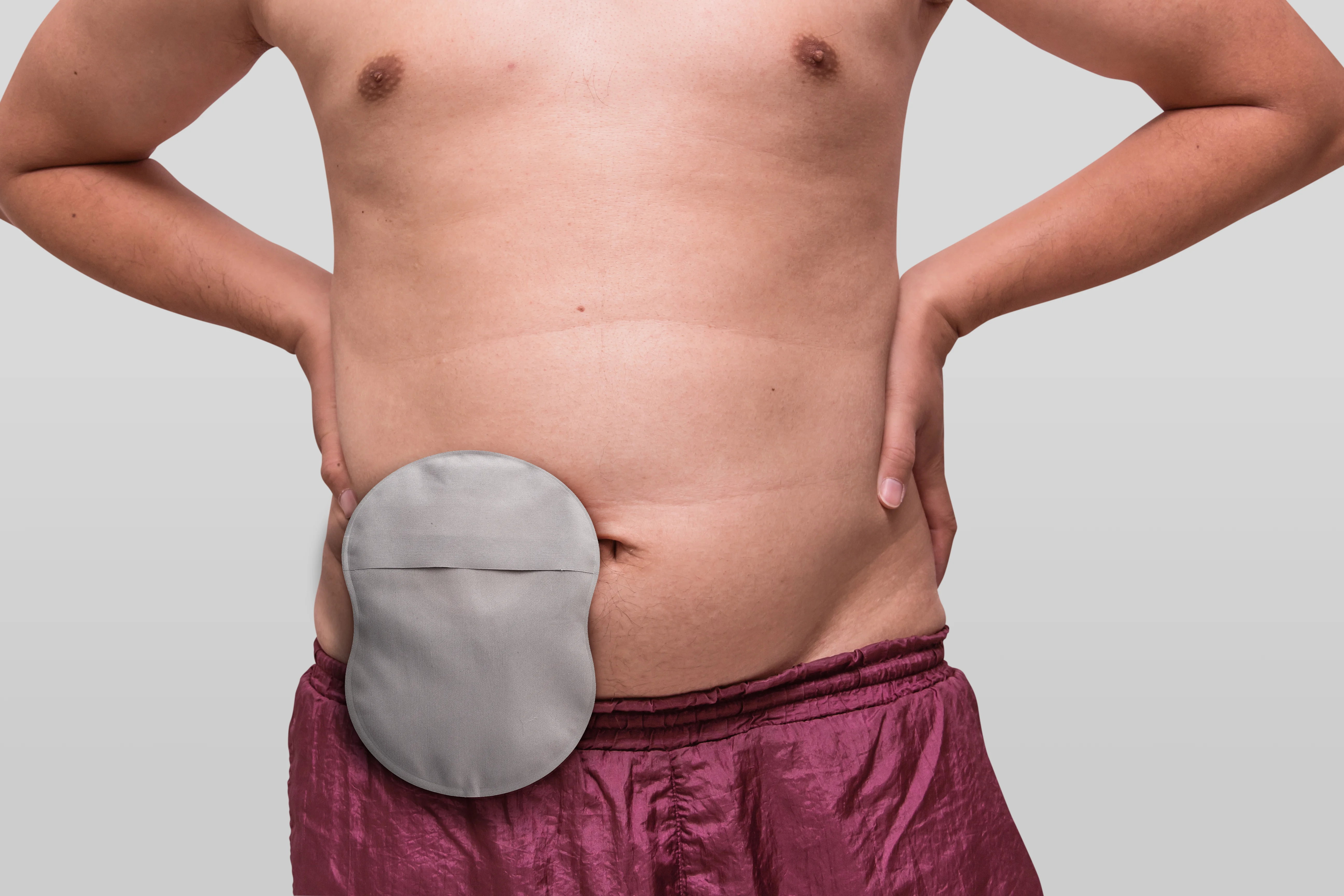 Hombre con una ostomía mostrando su bolsa
