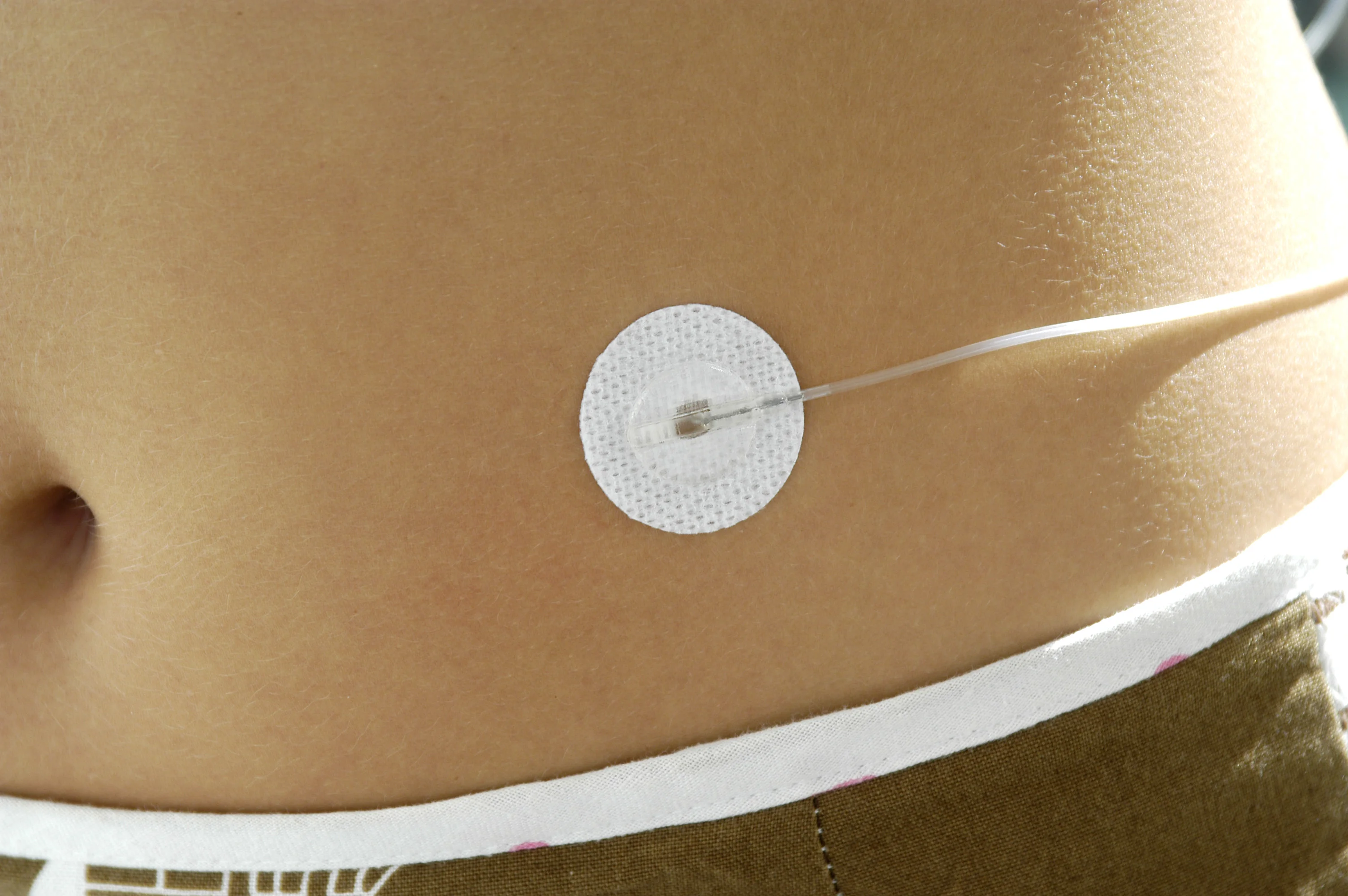 Set de perfusion Neria sur le corps